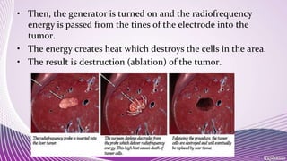 • Then, the generator is turned on and the radiofrequency
energy is passed from the tines of the electrode into the
tumor.
• The energy creates heat which destroys the cells in the area.
• The result is destruction (ablation) of the tumor.
 