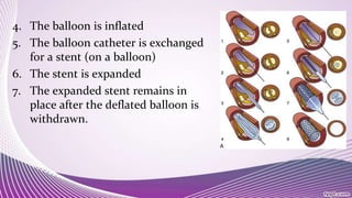4. The balloon is inflated
5. The balloon catheter is exchanged
for a stent (on a balloon)
6. The stent is expanded
7. The expanded stent remains in
place after the deflated balloon is
withdrawn.
 