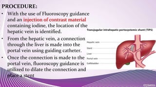 PROCEDURE:
• With the use of Fluoroscopy guidance
and an injection of contrast material
containing iodine, the location of the
hepatic vein is identified.
• From the hepatic vein, a connection
through the liver is made into the
portal vein using guiding catheter.
• Once the connection is made to the
portal vein, fluoroscopy guidance is
utilized to dilate the connection and
place a stent
 