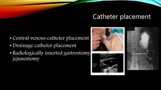 Catheter placement
• Central venous catheter placement
• Drainage catheter placement
• Radiologically inserted gastrostomy/
jejunostomy
 
