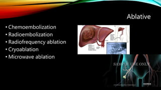 Ablative
• Chemoembolization
• Radioembolization
• Radiofrequency ablation
• Cryoablation
• Microwave ablation
 