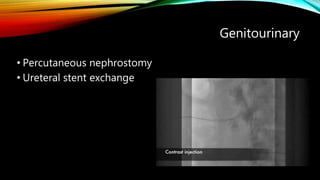 Genitourinary
• Percutaneous nephrostomy
• Ureteral stent exchange
 