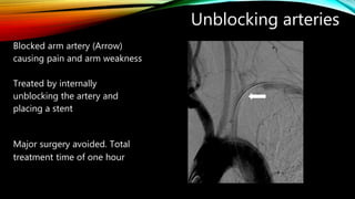 Unblocking arteries
Blocked arm artery (Arrow)
causing pain and arm weakness
Treated by internally
unblocking the artery and
placing a stent
Major surgery avoided. Total
treatment time of one hour
 