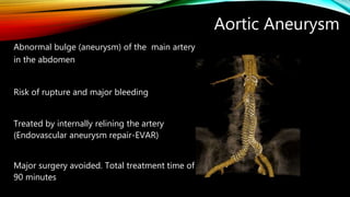 Aortic Aneurysm
Abnormal bulge (aneurysm) of the main artery
in the abdomen
Risk of rupture and major bleeding
Treated by internally relining the artery
(Endovascular aneurysm repair-EVAR)
Major surgery avoided. Total treatment time of
90 minutes
 