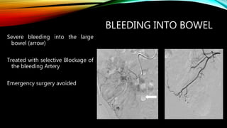 BLEEDING INTO BOWEL
Severe bleeding into the large
bowel (arrow)
Treated with selective Blockage of
the bleeding Artery
Emergency surgery avoided
 