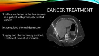 CANCER TREATMENT
Small cancer lesion in the liver (arrow)
in a patient with previously treated
cancer
Image guided thermal destruction
Surgery and chemotherapy avoided.
Treatment time of 60 minutes.
 