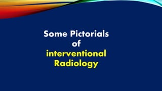 Some Pictorials
of
interventional
Radiology
 