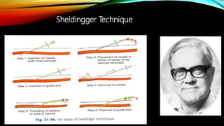 Sheldingger Technique
 