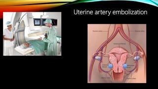 Uterine artery embolization
 