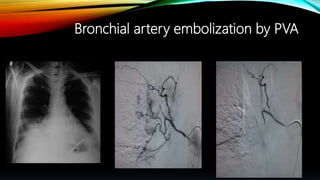 Bronchial artery embolization by PVA
 