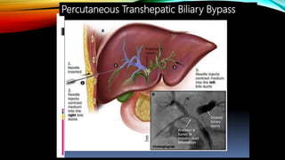 Percutaneous Transhepatic Biliary Bypass
 