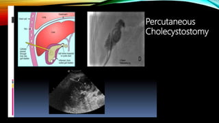 Percutaneous
Cholecystostomy
 