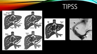 TIPSS
 