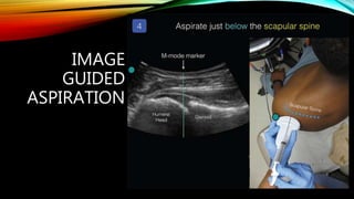 IMAGE
GUIDED
ASPIRATION
 