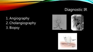 Diagnostic IR
1. Angiography
2. Cholangiography
3. Biopsy
 
