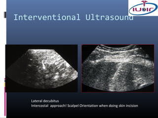 Interventional Ultrasound




   Lateral decubitus
   Intercostal approach! Scalpel Orientation when doing skin incision
 