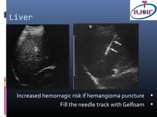 Liver




 Increased hemorragic risk if hemangioma puncture 
                 Fill the needle track with Gelfoam 
 