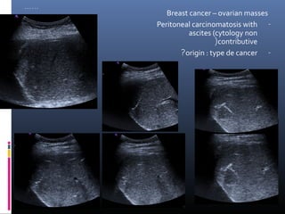 ……
        Breast cancer – ovarian masses
     Peritoneal carcinomatosis with -
               ascites (cytology non
                        (contributive
            ?origin : type de cancer -
 