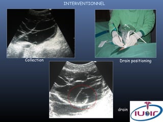 INTERVENTIONNEL




Collection                     Drain positioning




                               drain
 