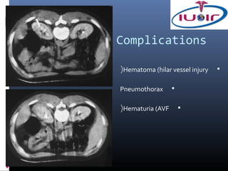 Complications

(Hematoma (hilar vessel injury   


Pneumothorax      


(Hematuria (AVF       
 