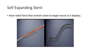 Self Expanding Stent
• Have radial force that anchors stent to target vessel as it deploys.
 
