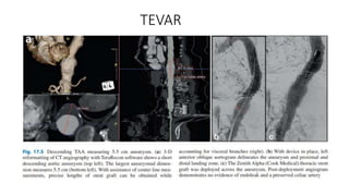 TEVAR
 