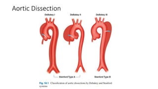 Aortic Dissection
 