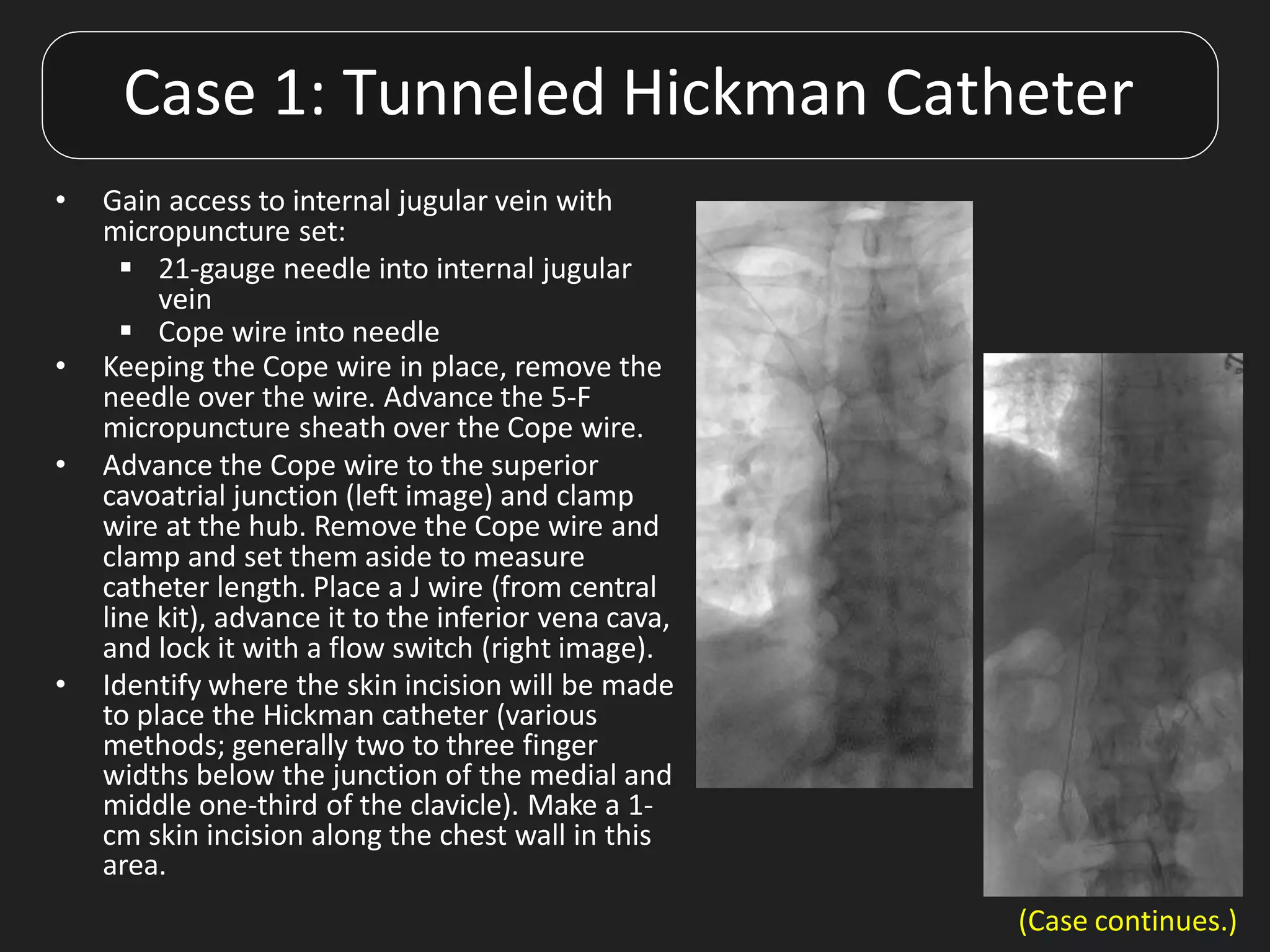 • Gain access to internal jugular vein with
micropuncture set:
 21-gauge needle into internal jugular
vein
 Cope wire into needle
• Keeping the Cope wire in place, remove the
needle over the wire. Advance the 5-F
micropuncture sheath over the Cope wire.
• Advance the Cope wire to the superior
cavoatrial junction (left image) and clamp
wire at the hub. Remove the Cope wire and
clamp and set them aside to measure
catheter length. Place a J wire (from central
line kit), advance it to the inferior vena cava,
and lock it with a flow switch (right image).
• Identify where the skin incision will be made
to place the Hickman catheter (various
methods; generally two to three finger
widths below the junction of the medial and
middle one-third of the clavicle). Make a 1-
cm skin incision along the chest wall in this
area.
Case 1: Tunneled Hickman Catheter
(Case continues.)
 