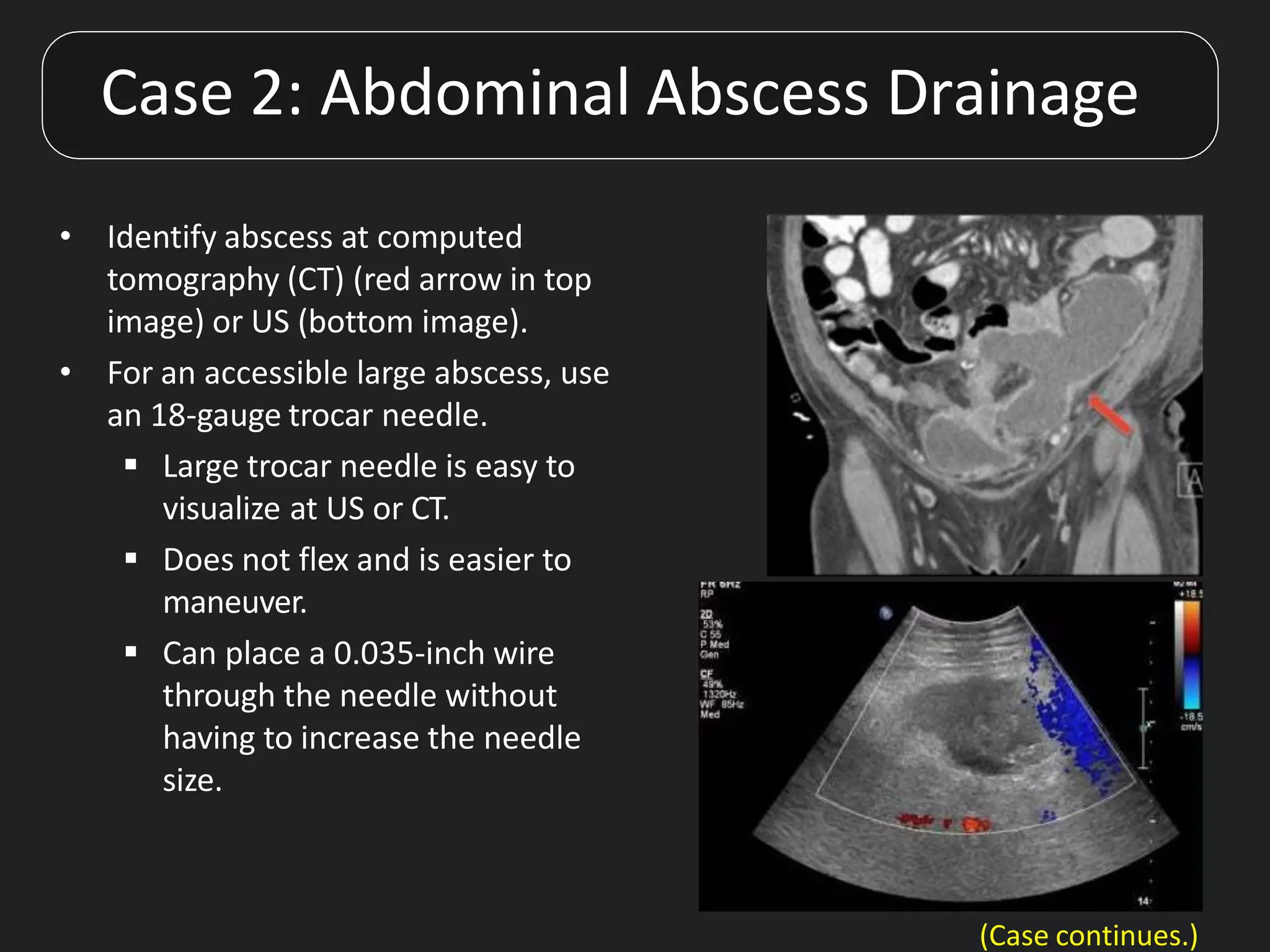 • Identify abscess at computed
tomography (CT) (red arrow in top
image) or US (bottom image).
• For an accessible large abscess, use
an 18-gauge trocar needle.
 Large trocar needle is easy to
visualize at US or CT.
 Does not flex and is easier to
maneuver.
 Can place a 0.035-inch wire
through the needle without
having to increase the needle
size.
Case 2: Abdominal Abscess Drainage
(Case continues.)
 