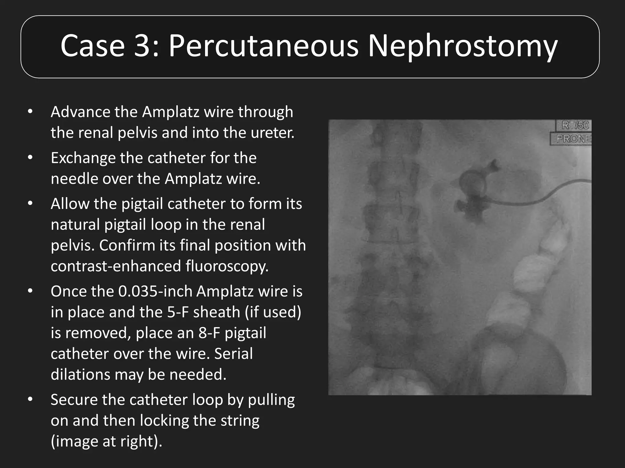 • Advance the Amplatz wire through
the renal pelvis and into the ureter.
• Exchange the catheter for the
needle over the Amplatz wire.
• Allow the pigtail catheter to form its
natural pigtail loop in the renal
pelvis. Confirm its final position with
contrast-enhanced fluoroscopy.
• Once the 0.035-inch Amplatz wire is
in place and the 5-F sheath (if used)
is removed, place an 8-F pigtail
catheter over the wire. Serial
dilations may be needed.
• Secure the catheter loop by pulling
on and then locking the string
(image at right).
Case 3: Percutaneous Nephrostomy
 