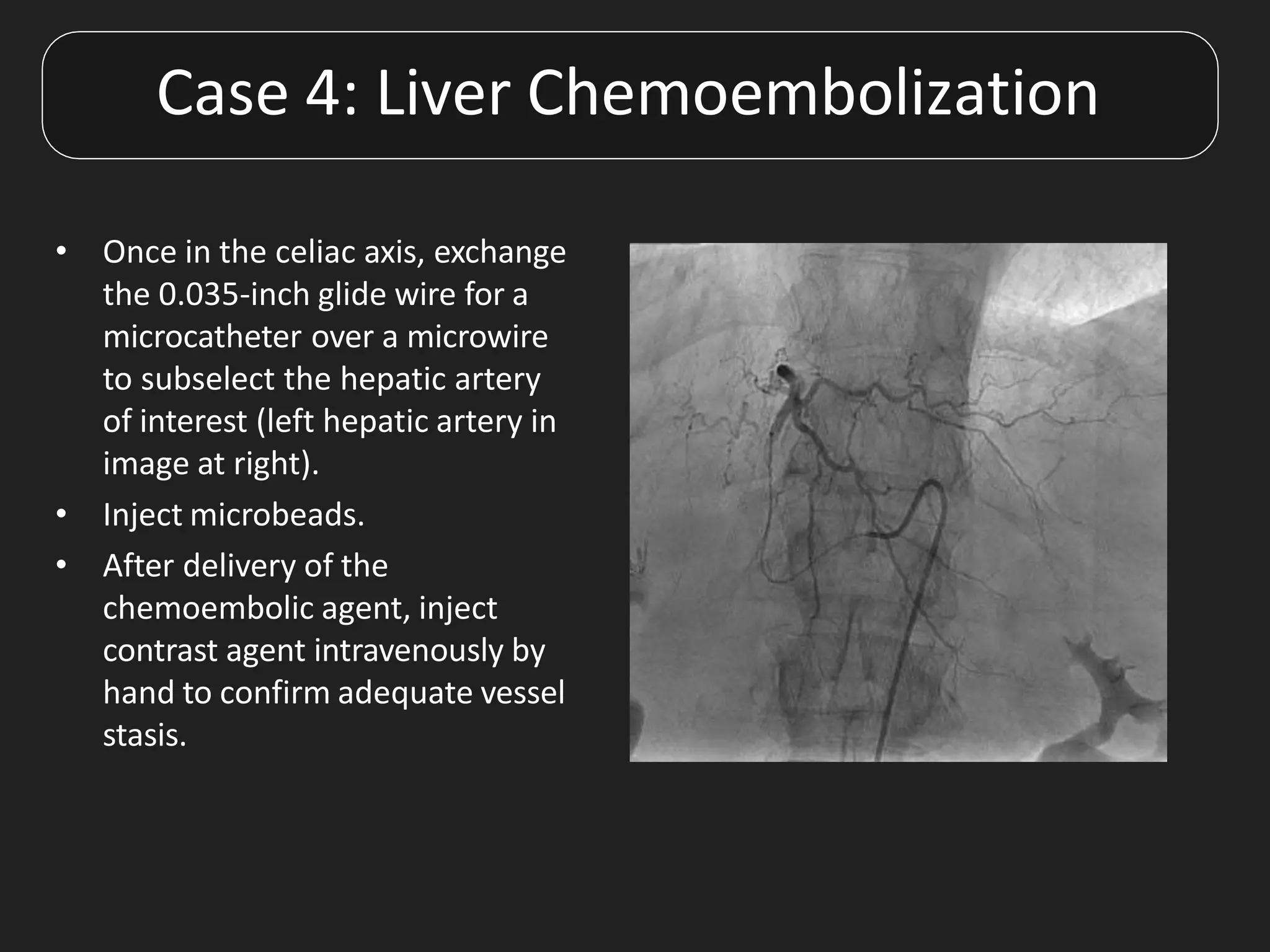 • Once in the celiac axis, exchange
the 0.035-inch glide wire for a
microcatheter over a microwire
to subselect the hepatic artery
of interest (left hepatic artery in
image at right).
• Inject microbeads.
• After delivery of the
chemoembolic agent, inject
contrast agent intravenously by
hand to confirm adequate vessel
stasis.
Case 4: Liver Chemoembolization
 