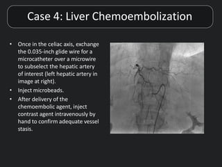 • Once in the celiac axis, exchange
the 0.035-inch glide wire for a
microcatheter over a microwire
to subselect the hepatic artery
of interest (left hepatic artery in
image at right).
• Inject microbeads.
• After delivery of the
chemoembolic agent, inject
contrast agent intravenously by
hand to confirm adequate vessel
stasis.
Case 4: Liver Chemoembolization
 