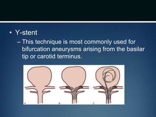 • Y-stent
– This technique is most commonly used for
bifurcation aneurysms arising from the basilar
tip or carotid terminus.
 