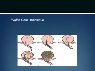 Waffle-Cone Technique
 