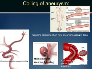 Coiling of aneurysm:
Following diagrams show how aneurysm coiling is done
Coil mass inside aneurysm
prevents blood from
entering it
 