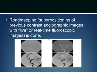 • Roadmapping (superpositioning of
previous contrast angiographic images
with “live” or real-time fluoroscopic
images) is done.
 