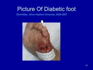 Picture Of Diabetic foot
Diabeticdermopathy.htm
DermAtlas, Johns Hopkins University; 2000-2007
13
 