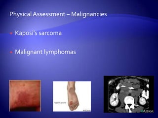 Physical Assessment – MalignanciesKaposi’s sarcomaMalignant lymphomas