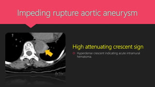Impeding rupture aortic aneurysm
High attenuating crescent sign
 Hyperdense crescent indicating acute intramural
hematoma.
 