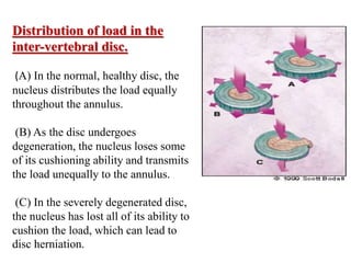 INTERVERTEBRAL DISC AND PROLAPSE OF INTERVERTREBRAL DISC.pptx