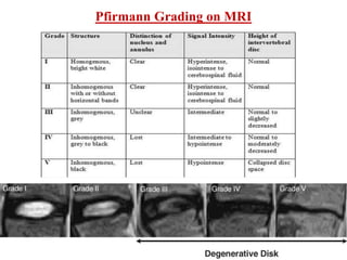 Grading Disc INTERVERTEBRAL DISC AND PROLAPSE OF INTERVERTREBRAL DISC.pptx