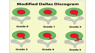 Grading Dallas Discogram Scale Intervertebral disc anatomy - Dr Sameep Koshti (Consultant Neurosurgeon ...