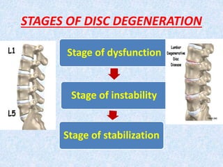 Intervertebral disc prolapese Slide 19