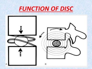 Intervertebral disc prolapese Slide 9