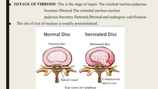 ■ 3)STAGE OF FIBROSIS :The is the stage of repair. The residual nucleus pulposus
becomes fibrosed.The extruded nucleus nucleus
pulposus becomes flattened,fibrosed and undergoes calcification.
■ The site of exit of nucleus is usually posteriolateral.
 