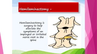 Hemilaminectomy -
Hemilaminectomy is
surgery to help
alleviate the
symptoms of an
impinged or irritated
nerve root in the
spine
 