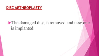 DISC ARTHROPLASTY
The damaged disc is removed and new one
is implanted
 