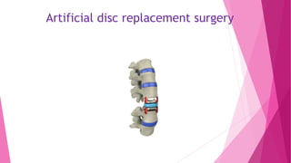 Artificial disc replacement surgery
 