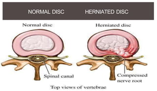 NORMAL DISC HERNIATED DISC
 