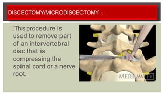 DISCECTOMY/MICRODISCECTOMY -
This procedure is
used to remove part
of an intervertebral
disc that is
compressing the
spinal cord or a nerve
root.
 